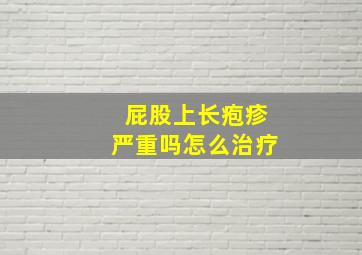 屁股上长疱疹严重吗怎么治疗