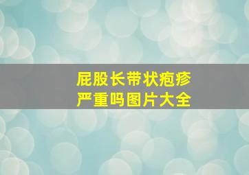 屁股长带状疱疹严重吗图片大全